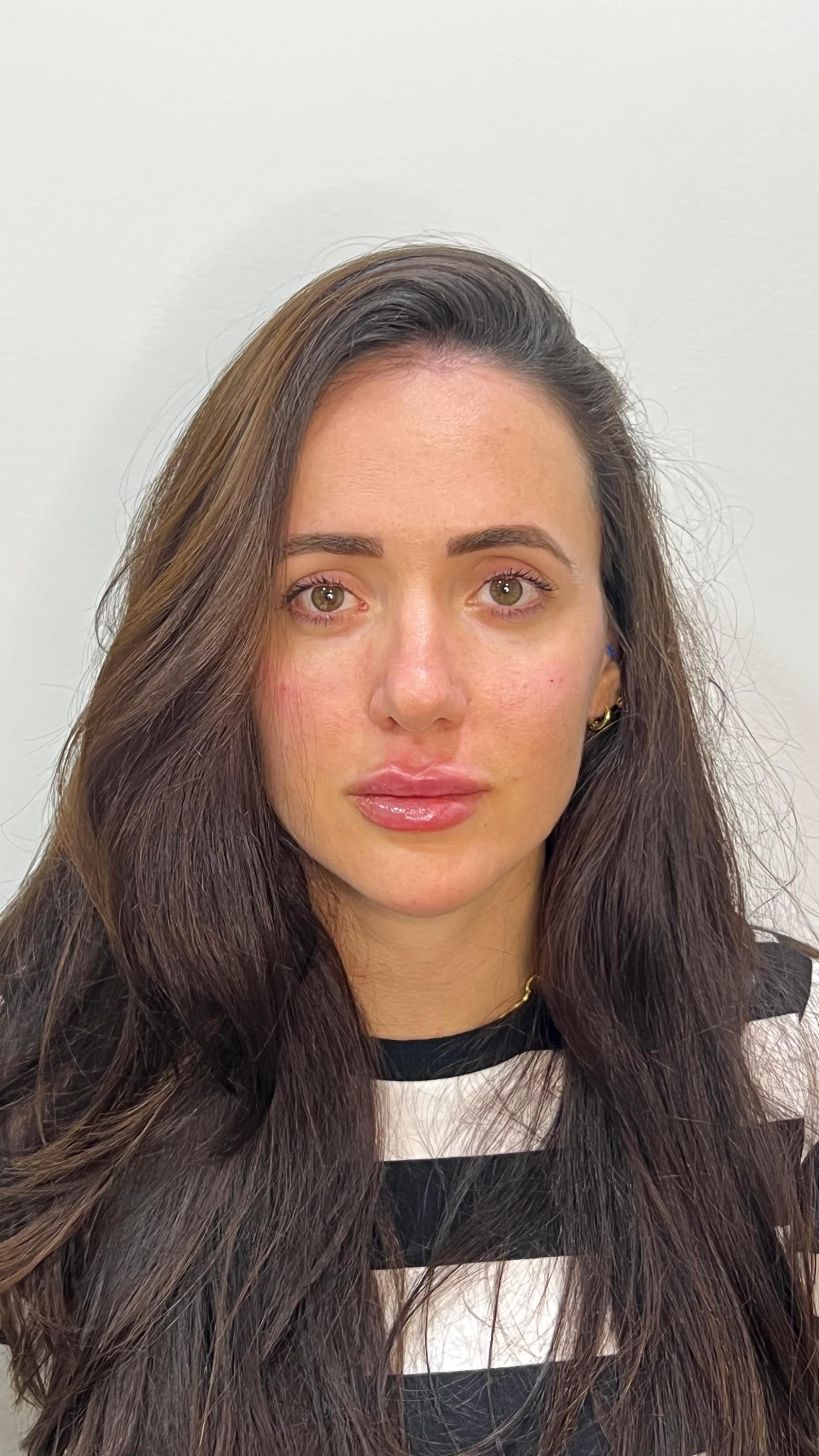Harmonização Facial